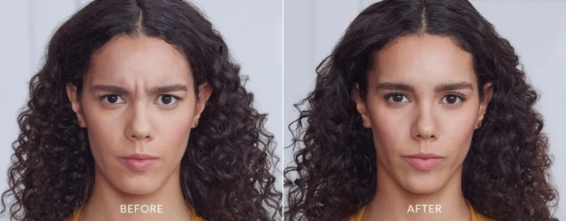 Botox-Before-and-After-02