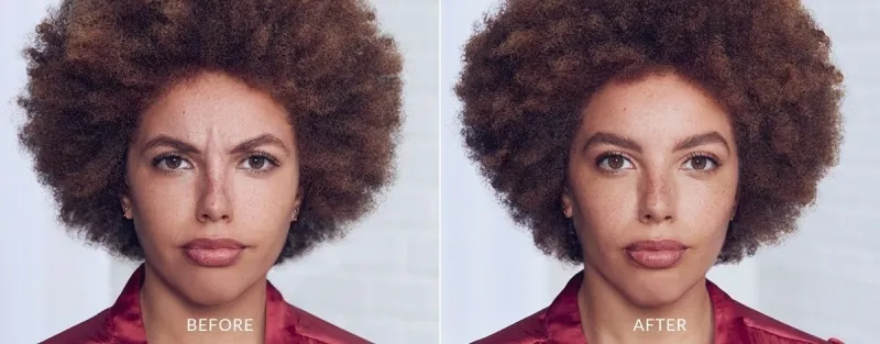 Botox-Before-and-After-03